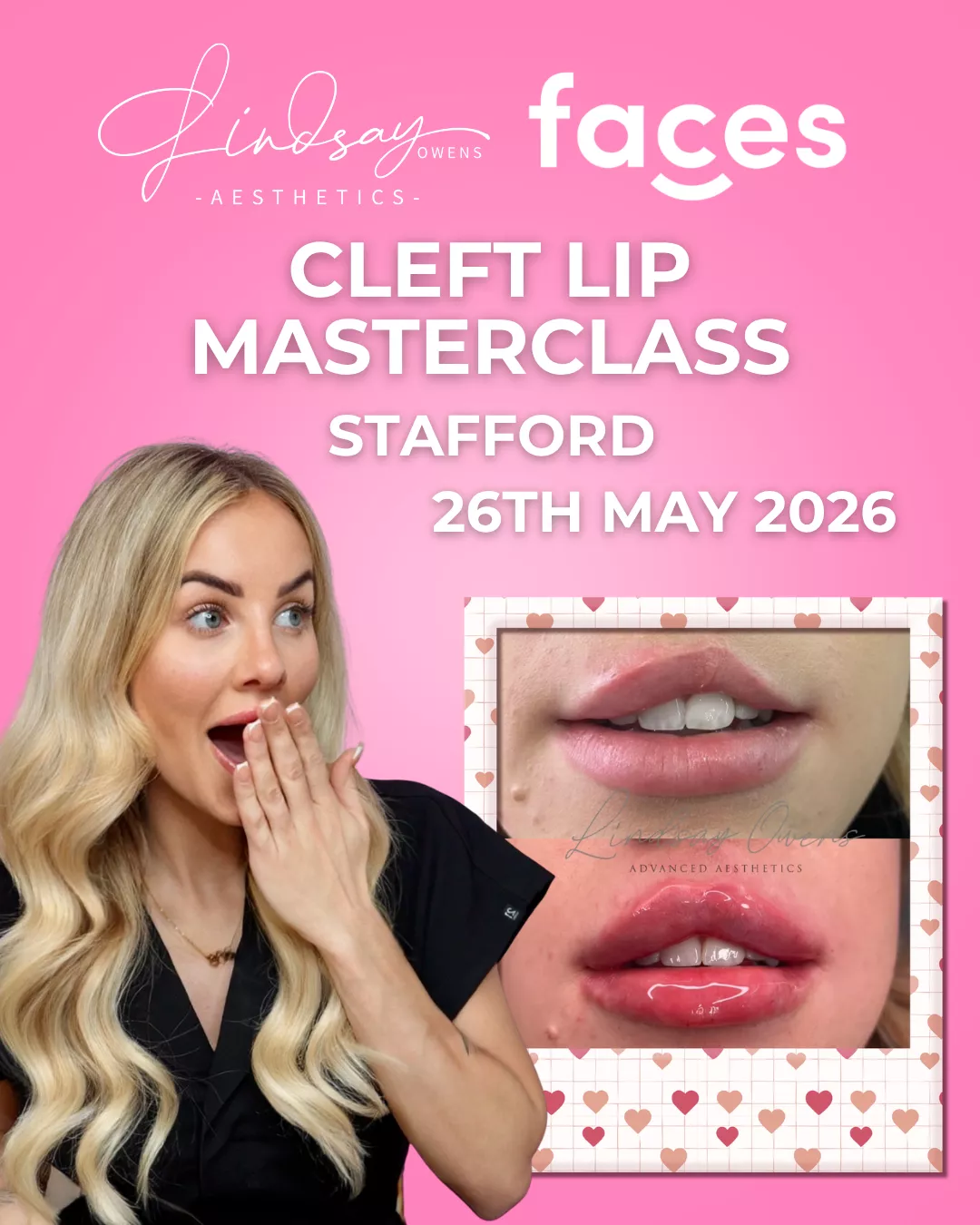 Cleft Lip Masterclass - Stafford image